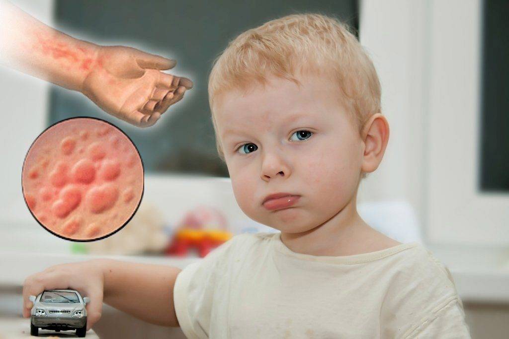 Аллергия у детей: симптомы, диагностика, лечение