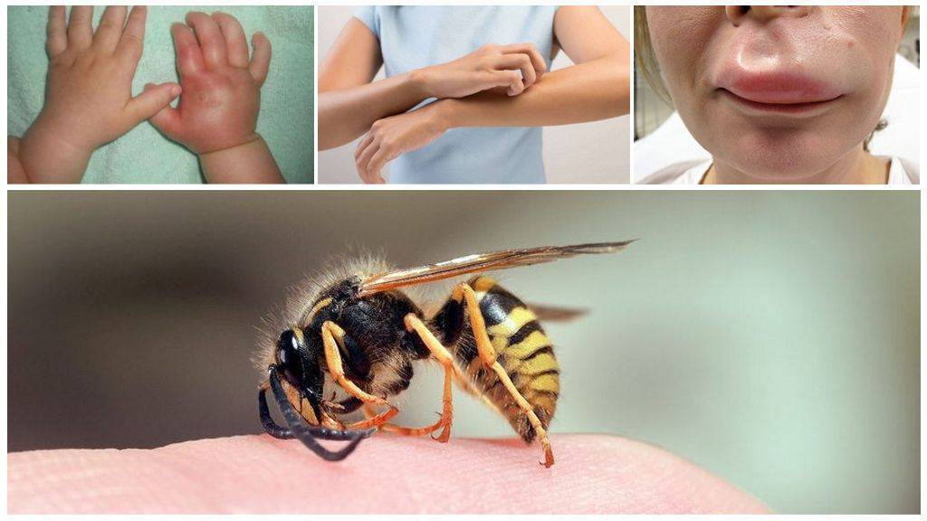 Что делать, если ребенка покусали комары, мошки, осы или пчелы?