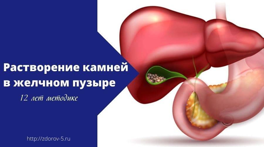 Желчнокаменная болезнь