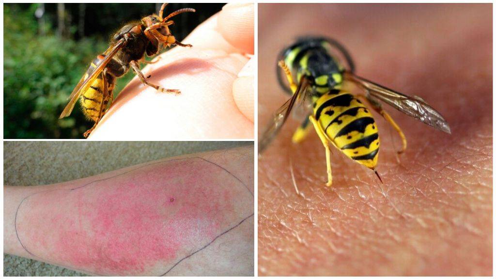 Аллергия на яд насекомых. лечение анафилаксии. что нужно знать врачу и пациенту | университетская клиника