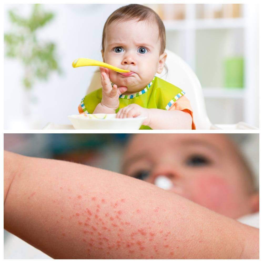 Пиуевая аллергия у ребёнка