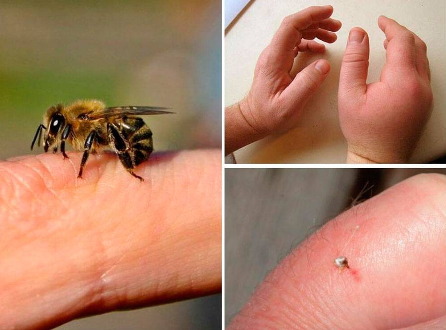 Аллергия на укусы насекомых. типы аллергических реакций. умеренная и острая  аллергия. что делать при укусе насекомых?