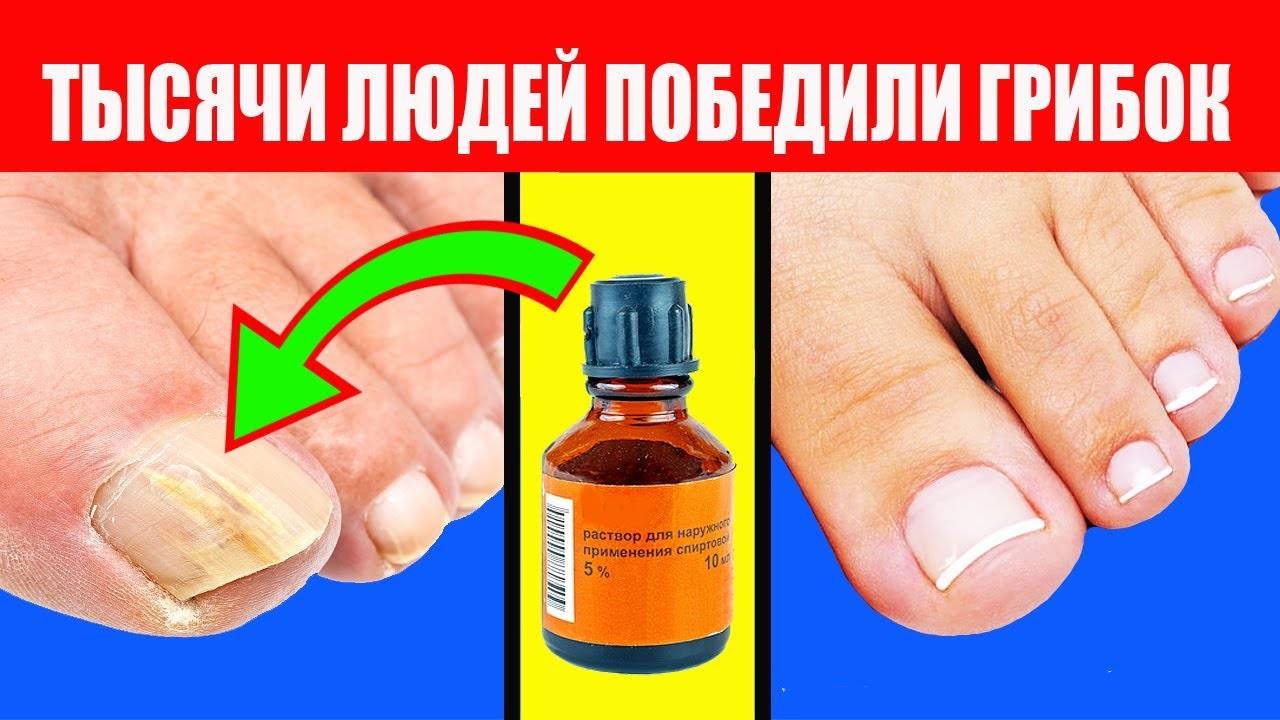 Как использовать лимон от грибка