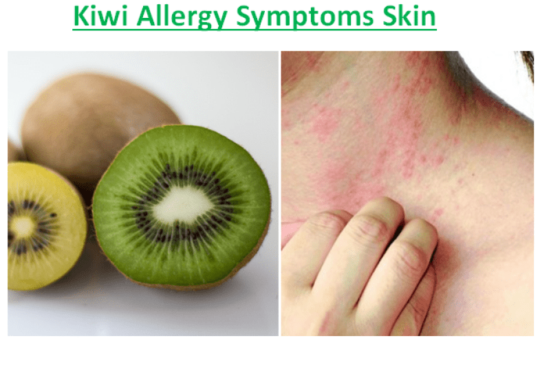 Есть ли аллергия на яблоки. Аллергия на цитрусовые фрукты. Аллергия на цитрус симптомы.